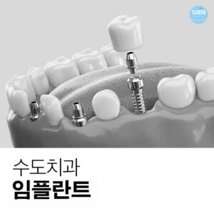 수도치과 임플란트