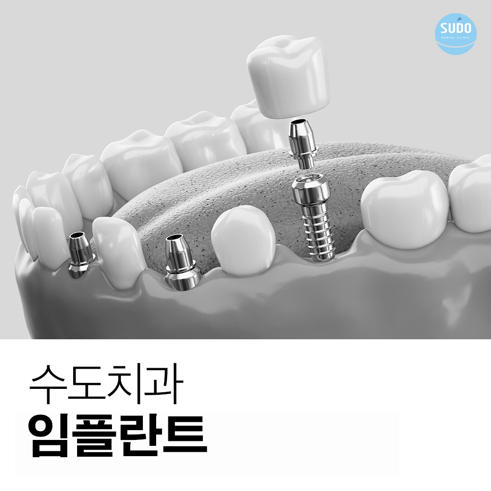 수도치과 임플란트