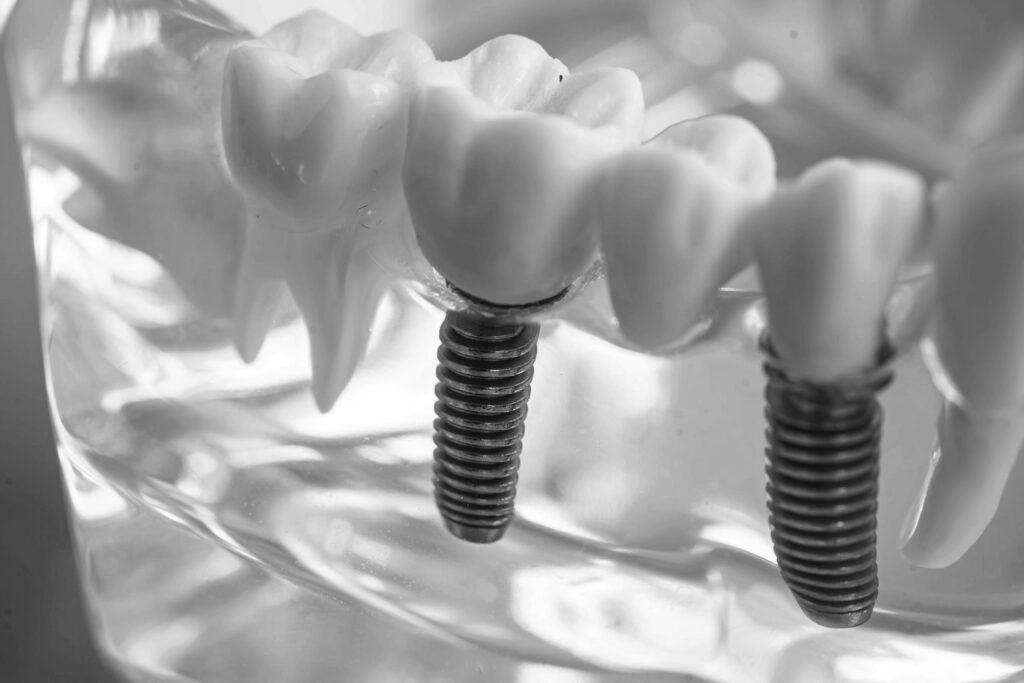 수도치과 임플란트