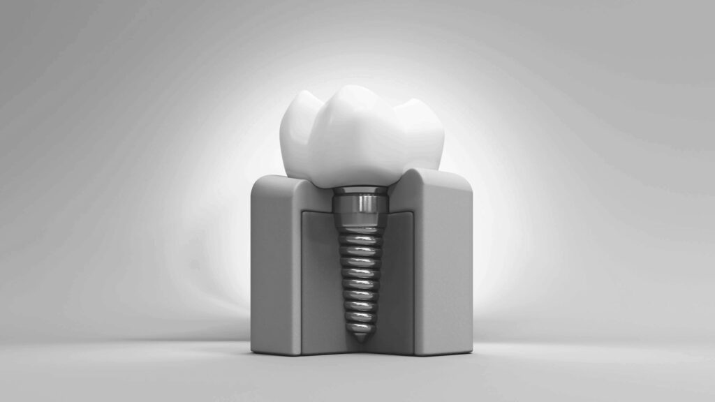 수도치과 임플란트