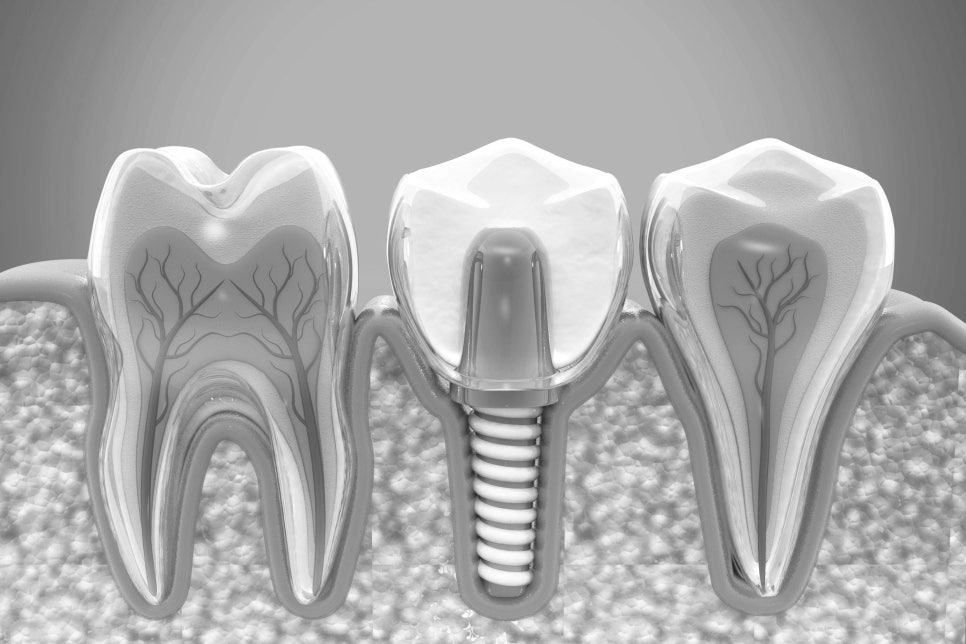 수도치과 임플란트