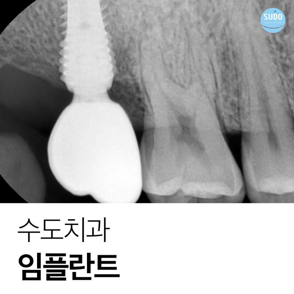 수도치과 임플란트