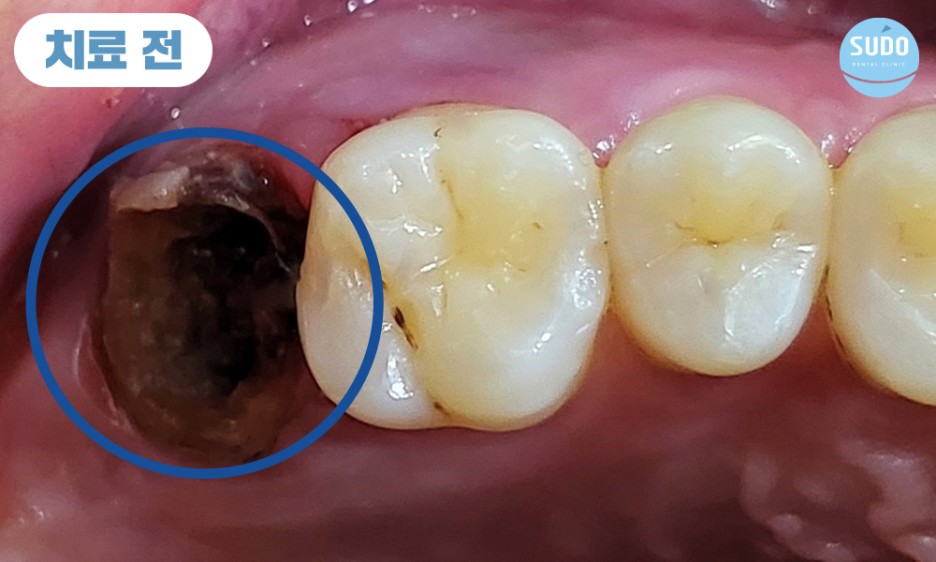 수도치과 임플란트
