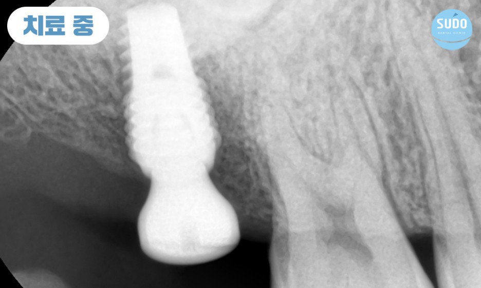 수도치과 임플란트