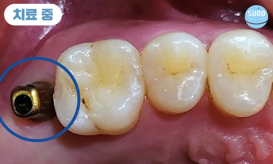 수도치과 임플란트