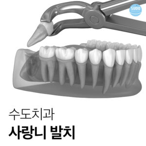 수도치과 사랑니발치