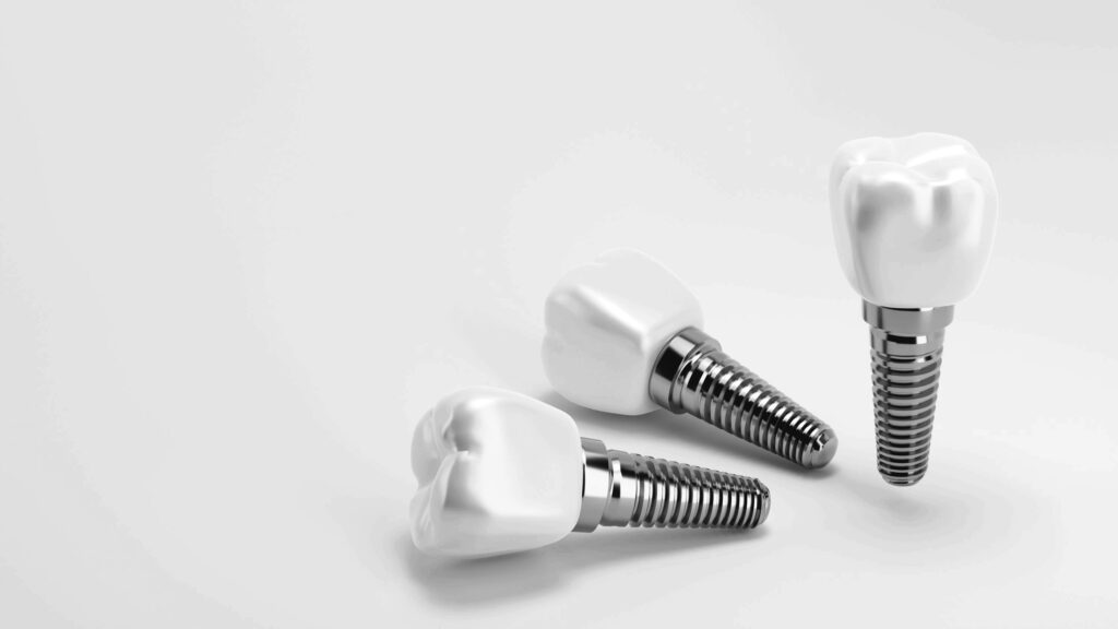 수도치과 임플란트