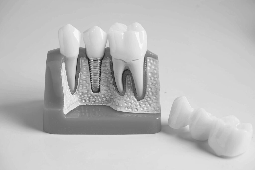 수도치과 임플란트