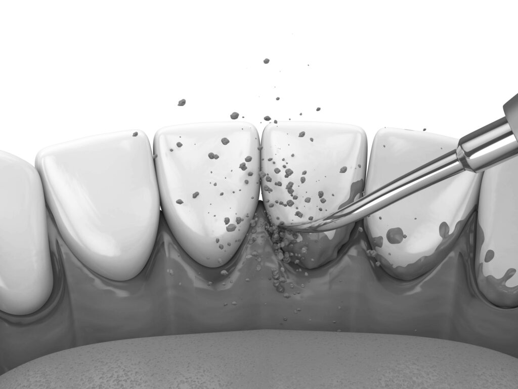 수도치과 스케일링