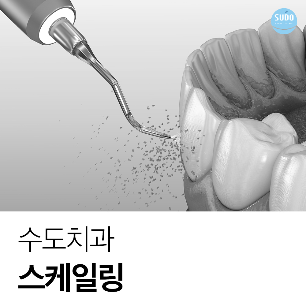 수도치과 스케일링