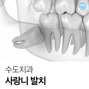 수도치과 사랑니발치