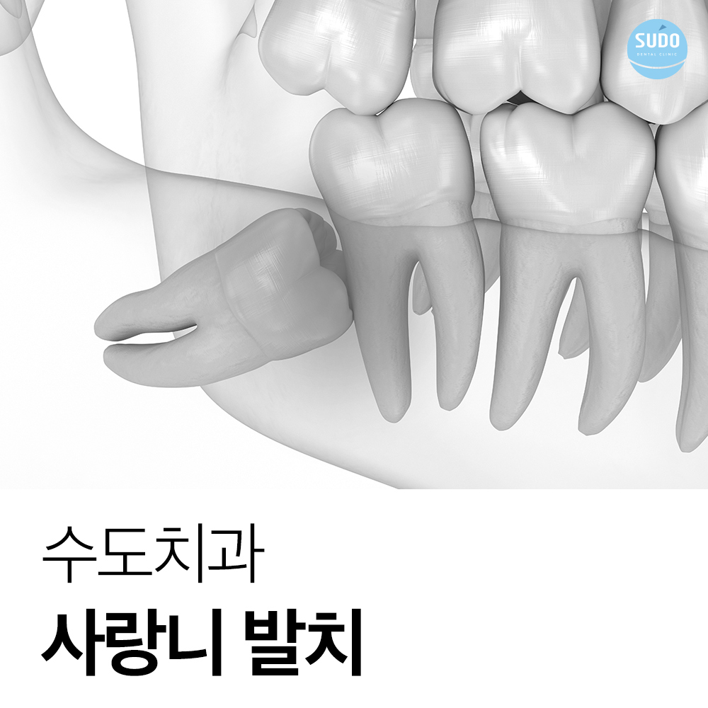 수도치과 사랑니발치