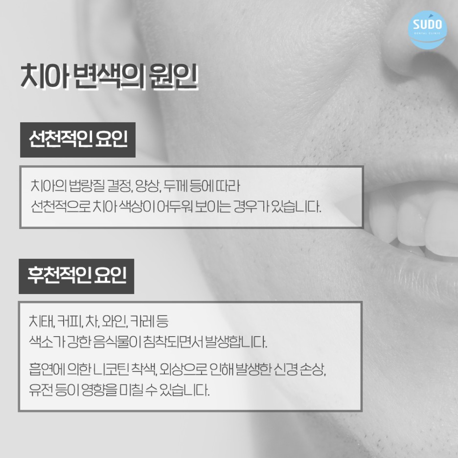 수도치과 치아미백