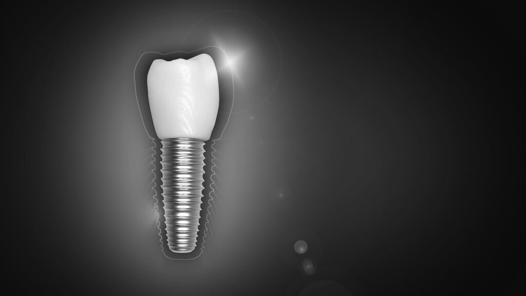 수도치과 임플란트