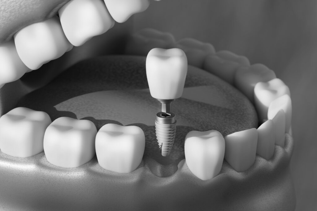 수도치과 임플란트