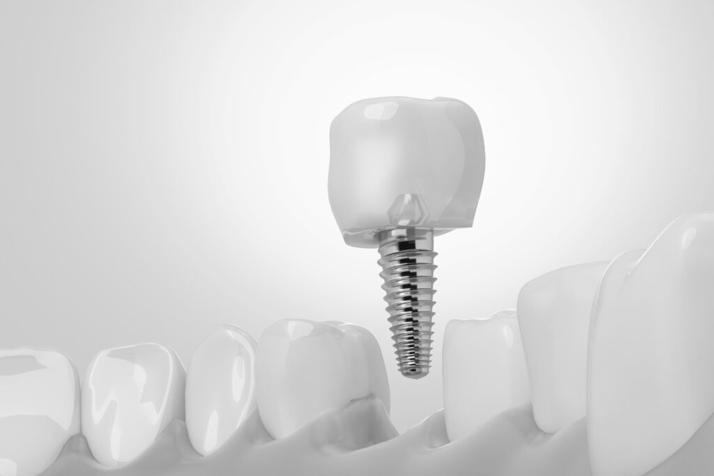 수도치과 임플란트