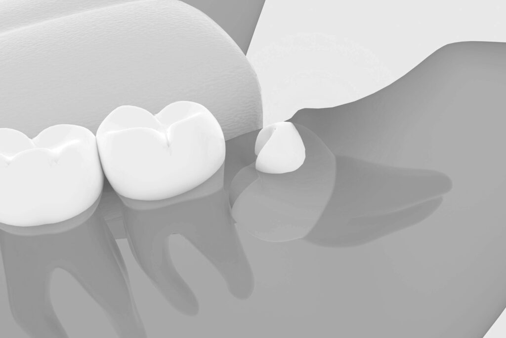 수도치과 사랑니발치