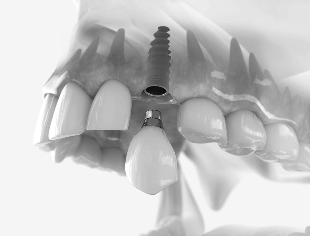 수도치과 임플란트