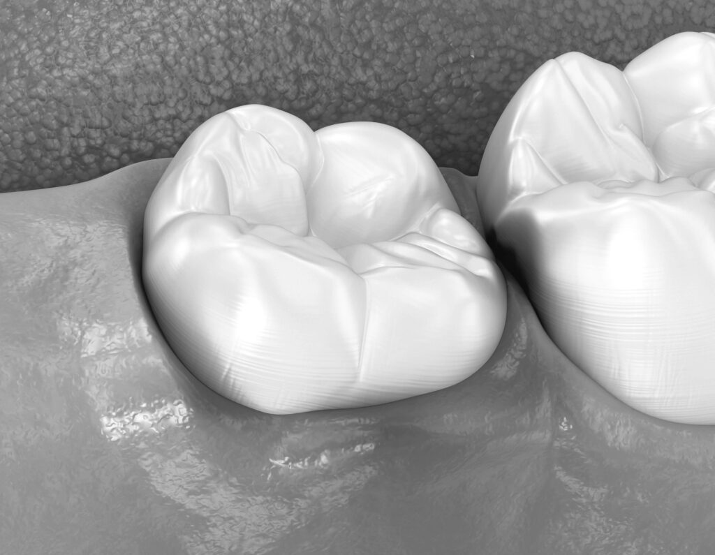 수도치과 사랑니발치