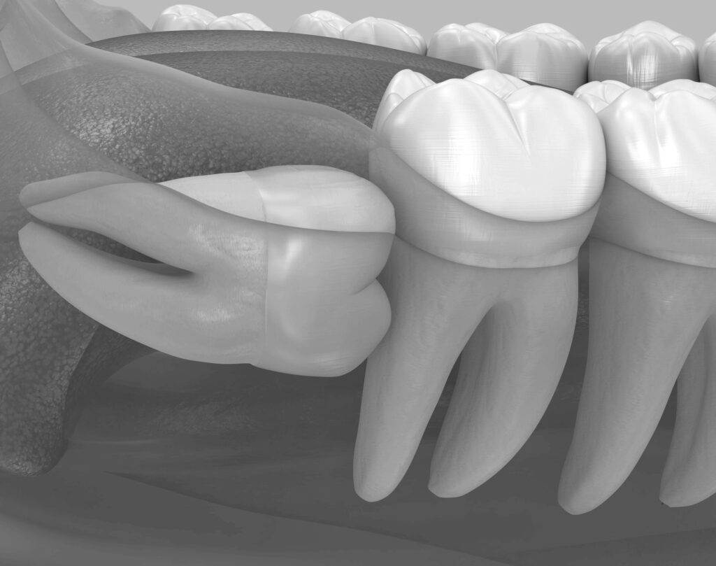 수도치과 사랑니발치