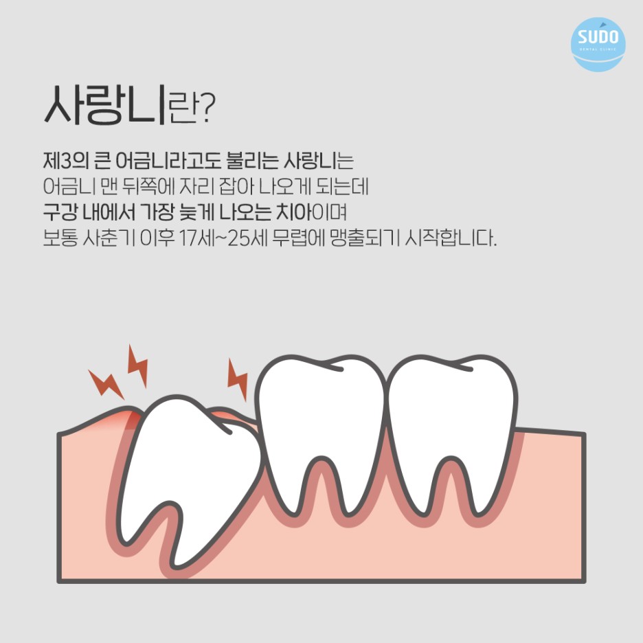수도치과 사랑니발치 후 충치치료