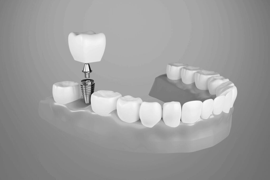 수도치과 임플란트