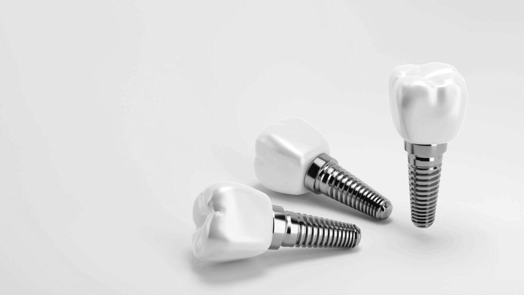 수도치과 임플란트