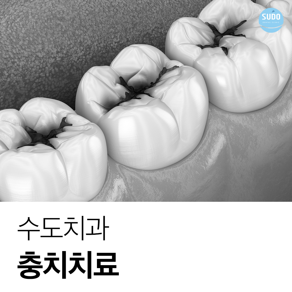 수도치과 충치치료