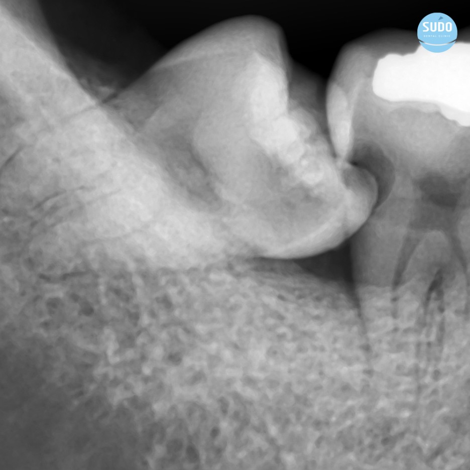 수도치과 사랑니발치 후 충치치료