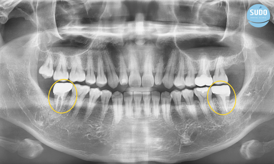 수도치과 사랑니발치 후 충치치료