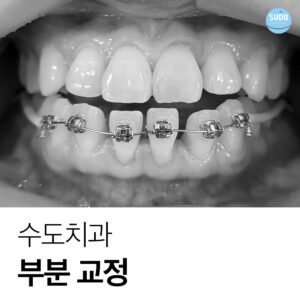 수도치과 치아교정