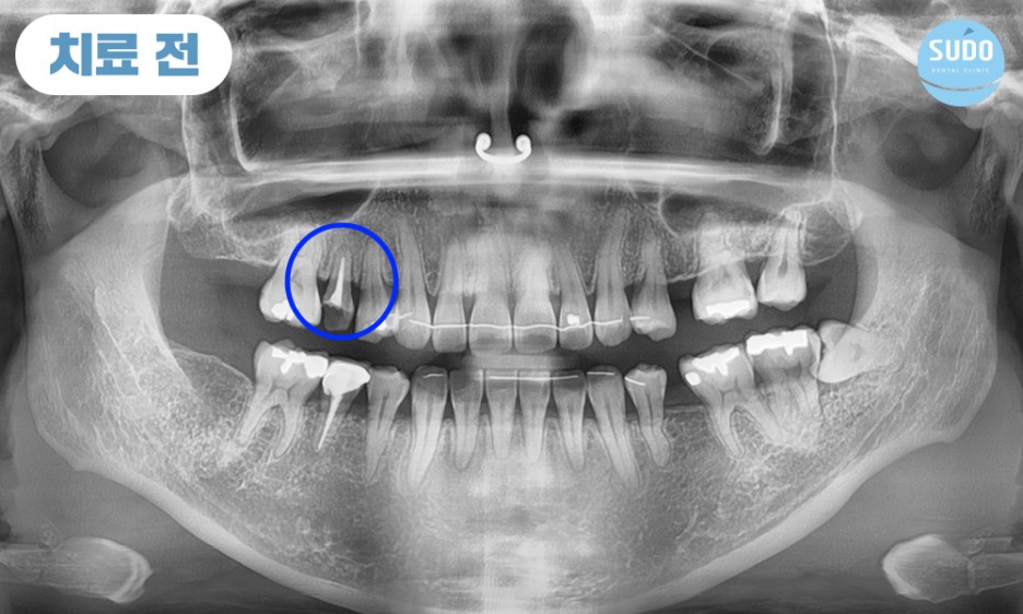 수도치과 임플란트