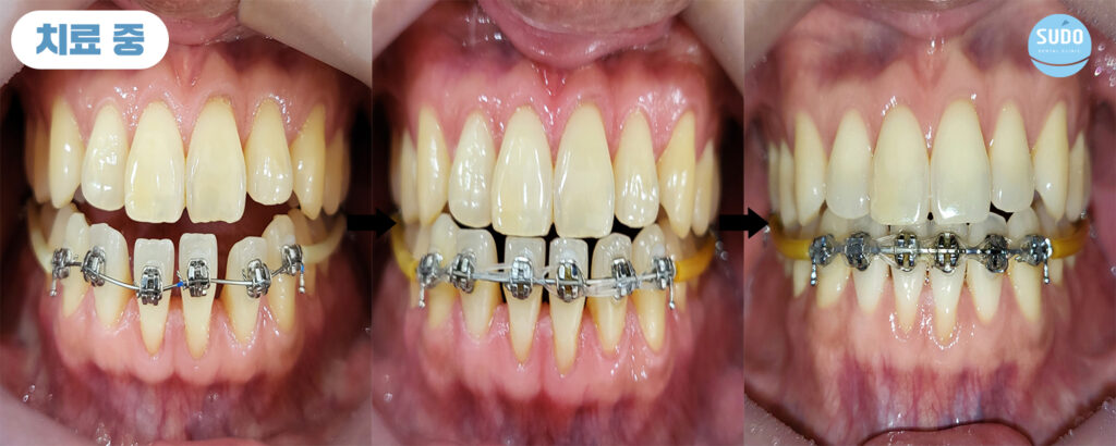수도치과 치아교정