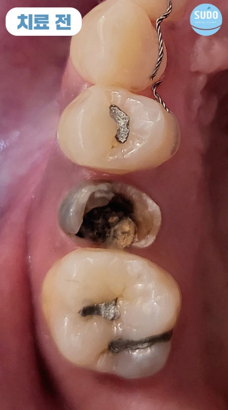 수도치과 임플란트