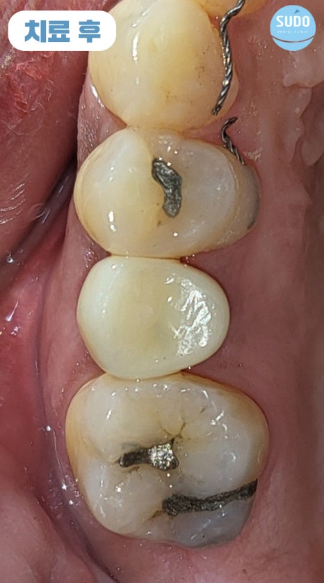 수도치과 임플란트