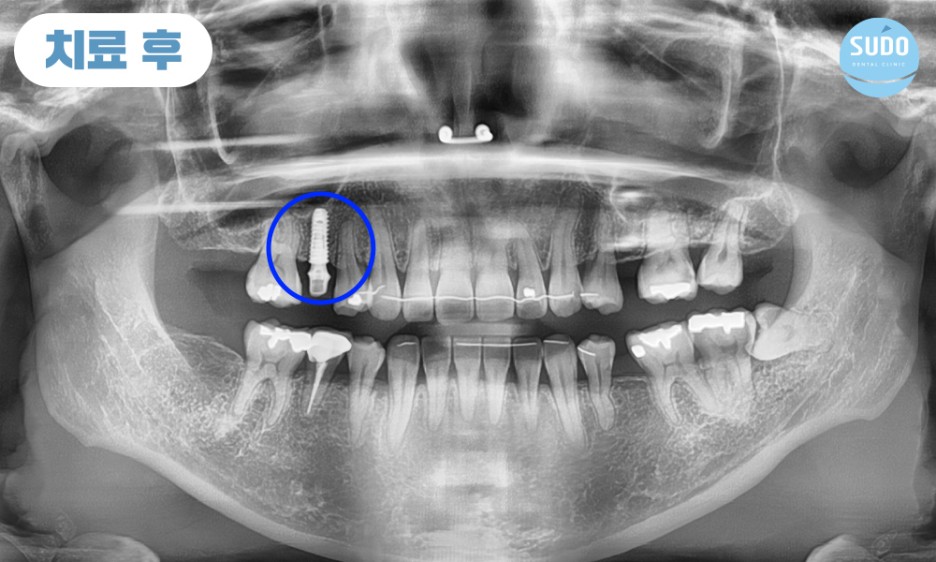 수도치과 임플란트
